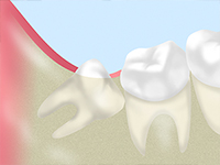 親知らずの痛みは早めに解決しましょう