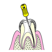 深いむし歯は根管治療が必要です