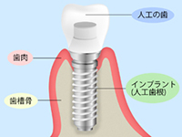 自分の歯のように噛めるインプラント