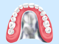 金属床義歯