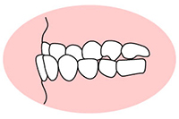 反対咬合(はんたこうごう)