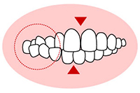 交叉咬合(こうさこうごう))