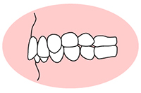 過蓋咬合(かがいこうごう)