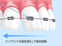 インプラント矯正