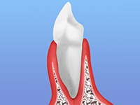 歯周病の可能性がある症状