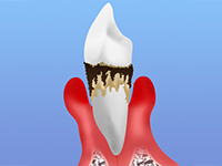 歯周病の可能性がある症状